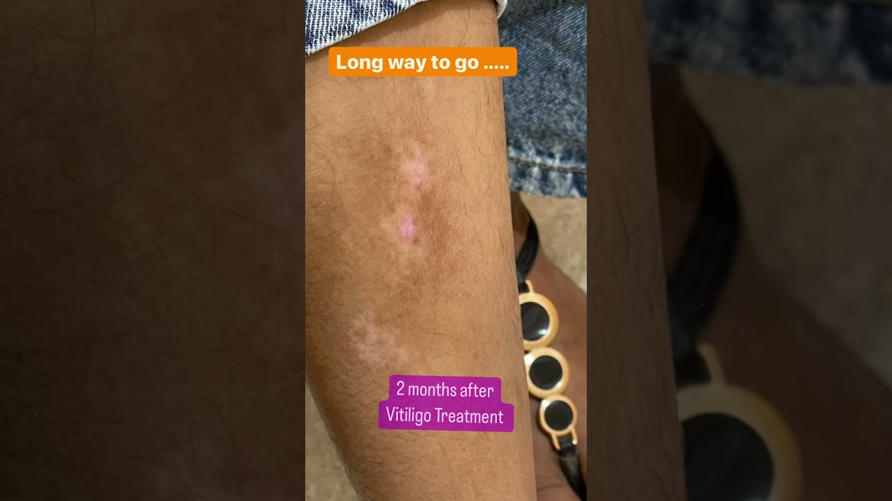 Vitiligo Treatment In Chandigarh Dermatologistinchandigarh Shorts