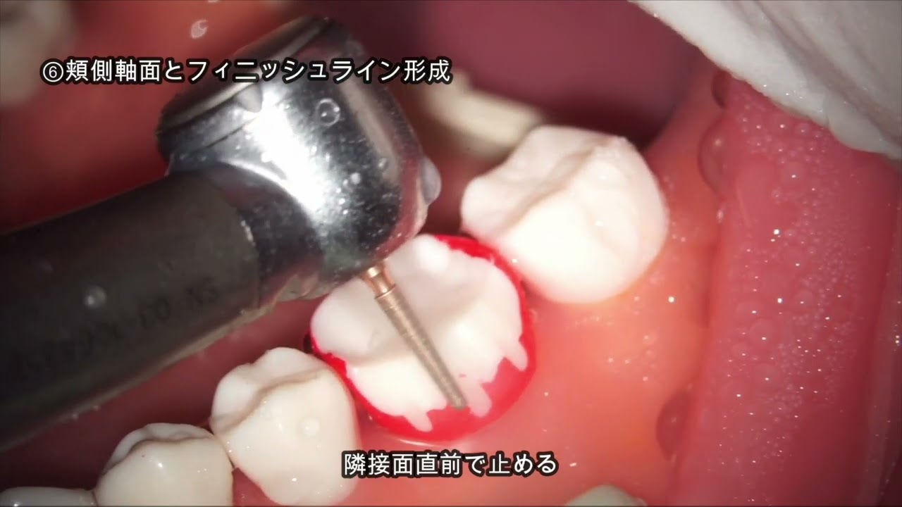 Dr. Kibayashi -匠- プレパレーションバーキット / 総合歯科材料商社