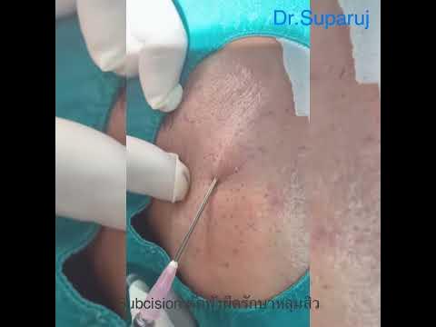 Ready go to ... https://bit.ly/3tSVZjN [ à¸à¸²à¸£à¸£à¸±à¸à¸©à¸²à¸«à¸¥à¸¸à¸¡à¸ªà¸´à¸§à¸à¹à¸§à¸¢à¸§à¸´à¸à¸µà¸à¸±à¸à¹à¸à¸²à¸°à¸à¸±à¸à¸à¸·à¸ Subcision for acne scar treatment]