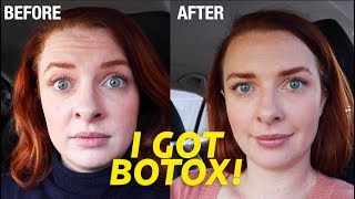 I Got Botox My Experience With Dr. Dhir Before And After