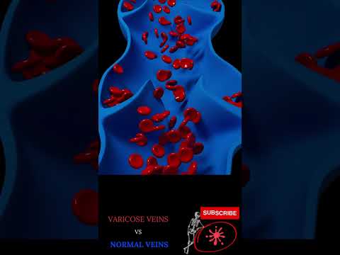 SPIDER veins (Varicose) vs normal veins blood flow