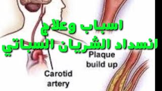 اسباب وعلاج انسداد الشريان السباتي. carotid artery stenosis causes and treatment