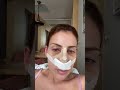 Getting A Nose Job In Turkey Vlog Nosejobinturkey Rhinoplasty
