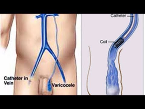 VARICOCELE/Infertility