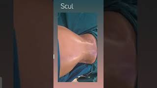 Body Contouring Done Right