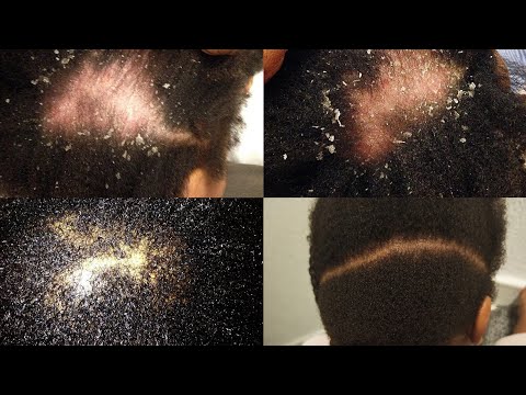 HOW TO TREAT ITCHY, DRY, FLAKY SCALP WITH OILS.Toddlers Fungal infection? Tinea Capitis?  Psoriasis?
