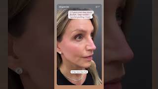 Full Facial Rejuvenation Before &amp; After | 1.5-Year Results