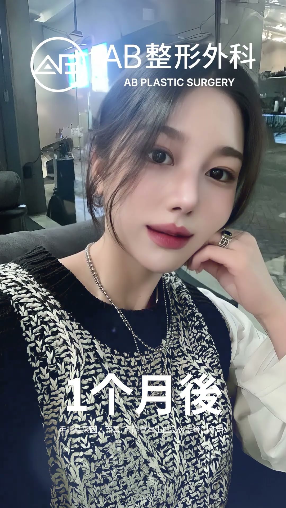 從普通到驚艷！她的隆鼻前後對比太震撼了！😱✨ #热门 #推荐