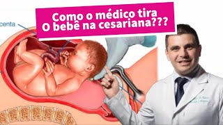 Como o médico tira o bebê na cesariana? Como o médico tira o bebê na cesariana?