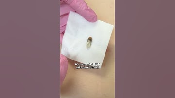 Extraction of an Omphalolith in a Patient