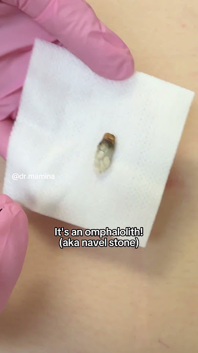 Extraction of an Omphalolith in a Patient's belly button