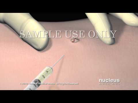 Video: Cómo curarse de una biopsia de piel (con imágenes)