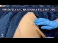 Non-Surgical Solutions for Hip Dips and Stretch Marks: A Comprehensive Discussion on PRP and Alternative Treatments