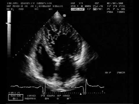 echocardiogram : LV Non compaction - YouTube