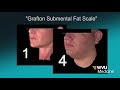 Double Chin Reduction with Kybella - WVU Medicine Health Report