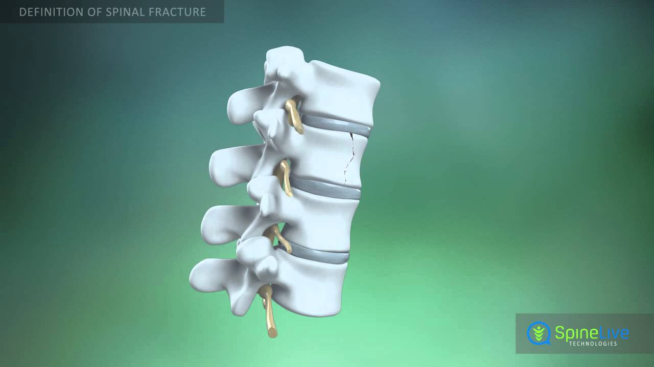 Spinal fractures. Definition