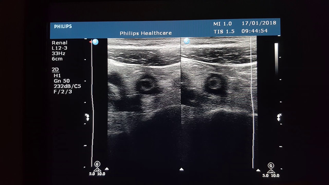 Appendicitis Sonography Youtube