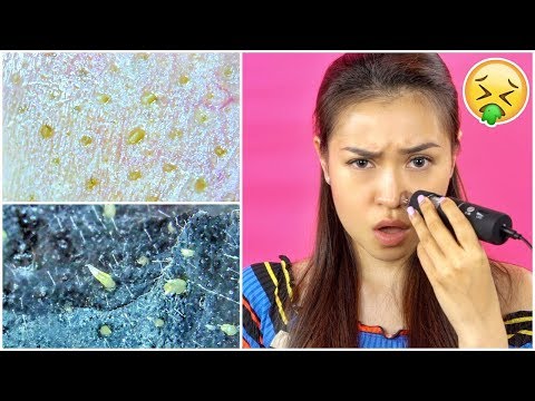 🤢MỤN CÁM Nhìn Thế Nào Dưới KÍNH HIỂN VI...?!? 🤢 ||  Newin