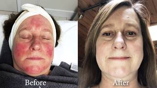Ipl Treament For Rosacea