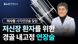 (의사용 사지연장술) 저신장 환자를 위한 경골 내고정 연장술 Tibial Lengthening Over an Intramedullary Nail for short stature