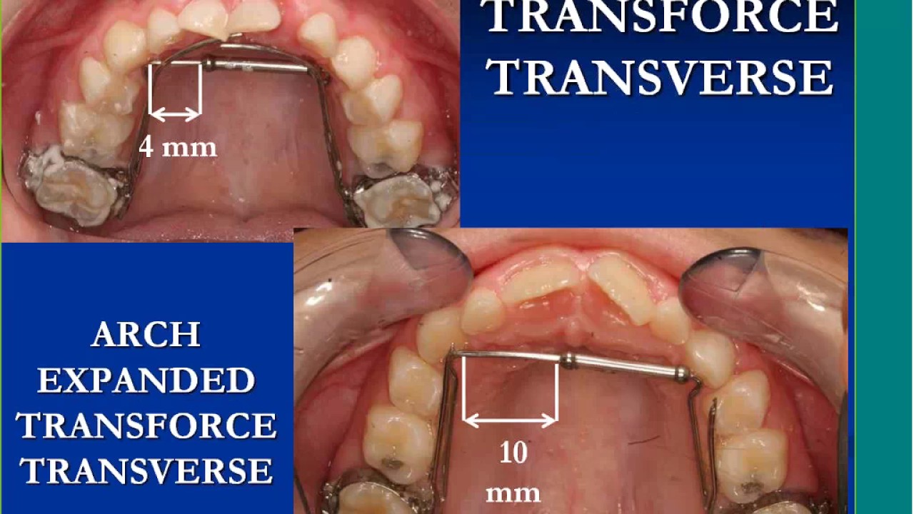 SML inar Series Early Orthodontic Treatment YouTube