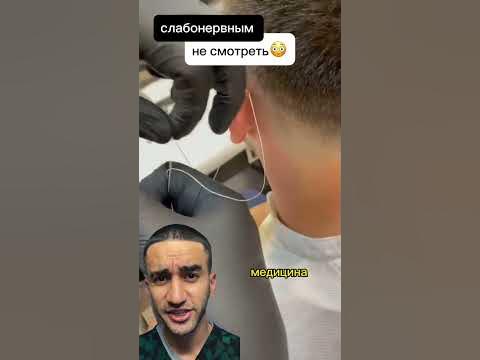 удаление родинок или как делать не стоит - YouTube
