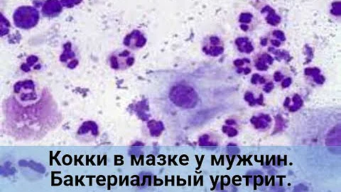 Кокки в мазке у мужчин. Бактериальный уретрит.