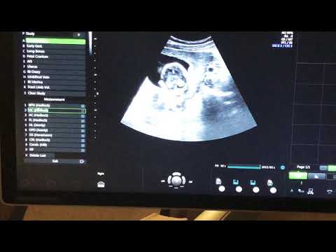 Video: Ultrason Taramasında Bir çocuğun Ağırlığı Nasıl Belirlenir