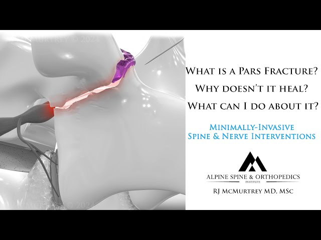 Animation Pars Defect What Is A Pars Fracture Defect The Trauma Pro