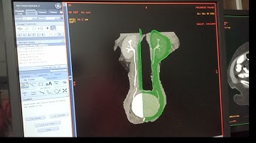 Post processing on ge ADW CT UROGRAPHY # @MRICTScanTech @3DParamedical