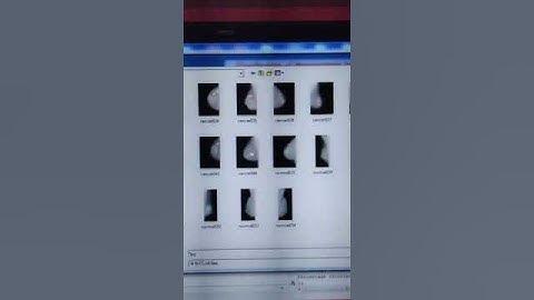 Classification of Mammogram Images using GLCM and Trace Transform Functionals