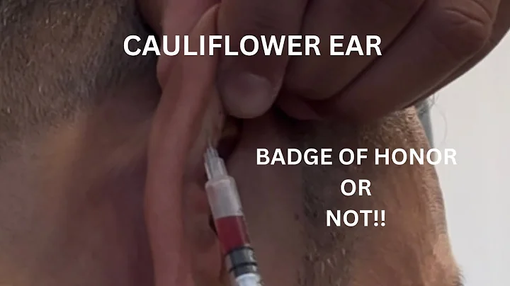 Cauliflower ear! This is how I drain it.