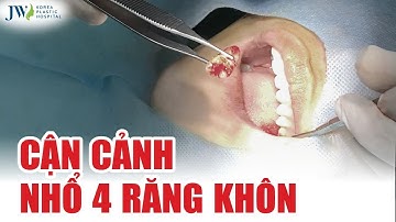 CẬN CẢNH NHỔ 4 RĂNG KHÔN cùng lúc, giải quyết ĐAU RĂNG lập tức