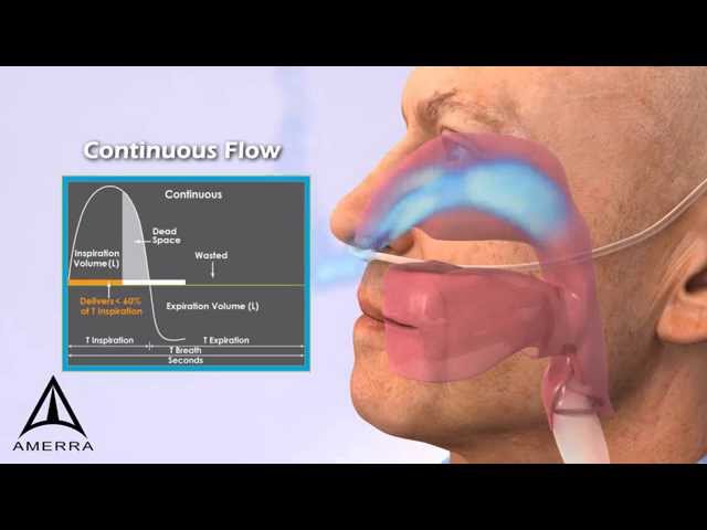 Amerra 3D Medical Animation - LifeChoice Activox Portable Oxygen Concentrator class=