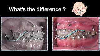 Use of Elastics and Space Generation in Midline Correction｜【Chris Chang Ortho】CC489