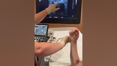 Dynamic wrist ultrasound of extensor carpi ulnaris (ECU) tendon to r/o subluxation or dislocation