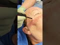 Renuvion Facial Renewal