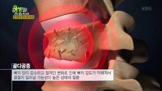 2TV 저녁 생생정보 플러스 - 소리 없는 뼈 도둑, 골다공증!. 20151228