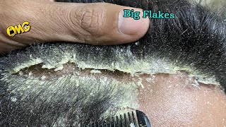 DRY SCALP !! Big Flakes Dandruff Scratching #23