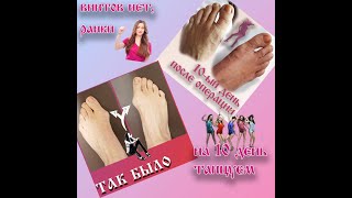 Отзыв о малоинвазивной операции на стопах Hallux valgus