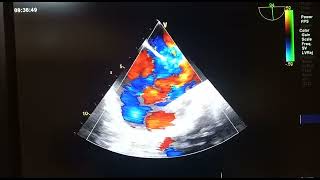 Sinus Venosus Asd Svc Type Tee Bicaval View