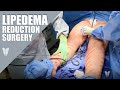 Lipedema reduction surgery  preop  procedure  total lipedema care