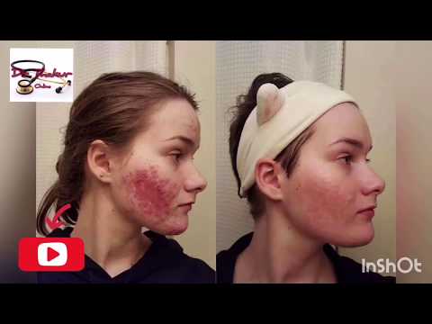 #trending-#english-#acne-acne-treatment-,remedy-,tips-by-dr-thakur
