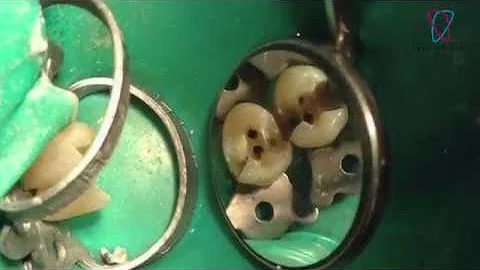 ¿Qué debo esperar de mi primera endodoncia?