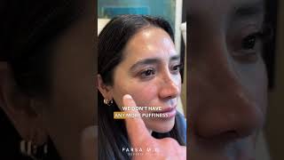 3 Months After Dark Circles & Puffy Eye Bags Treatment with Dr. Kami Parsa | Trifecta Lift