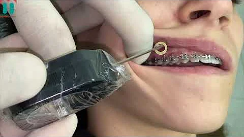 Em qual dente colocar o elástico?