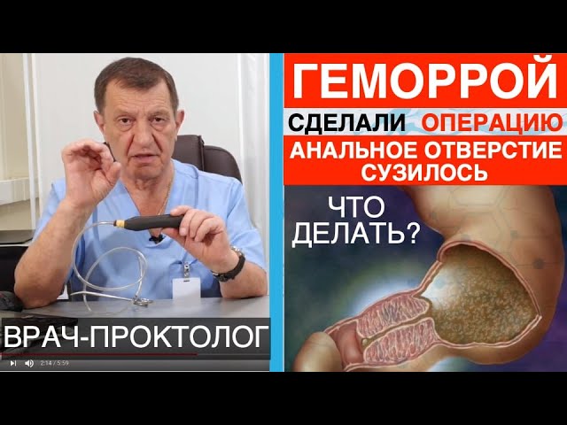 Сужение Анального Отверстия