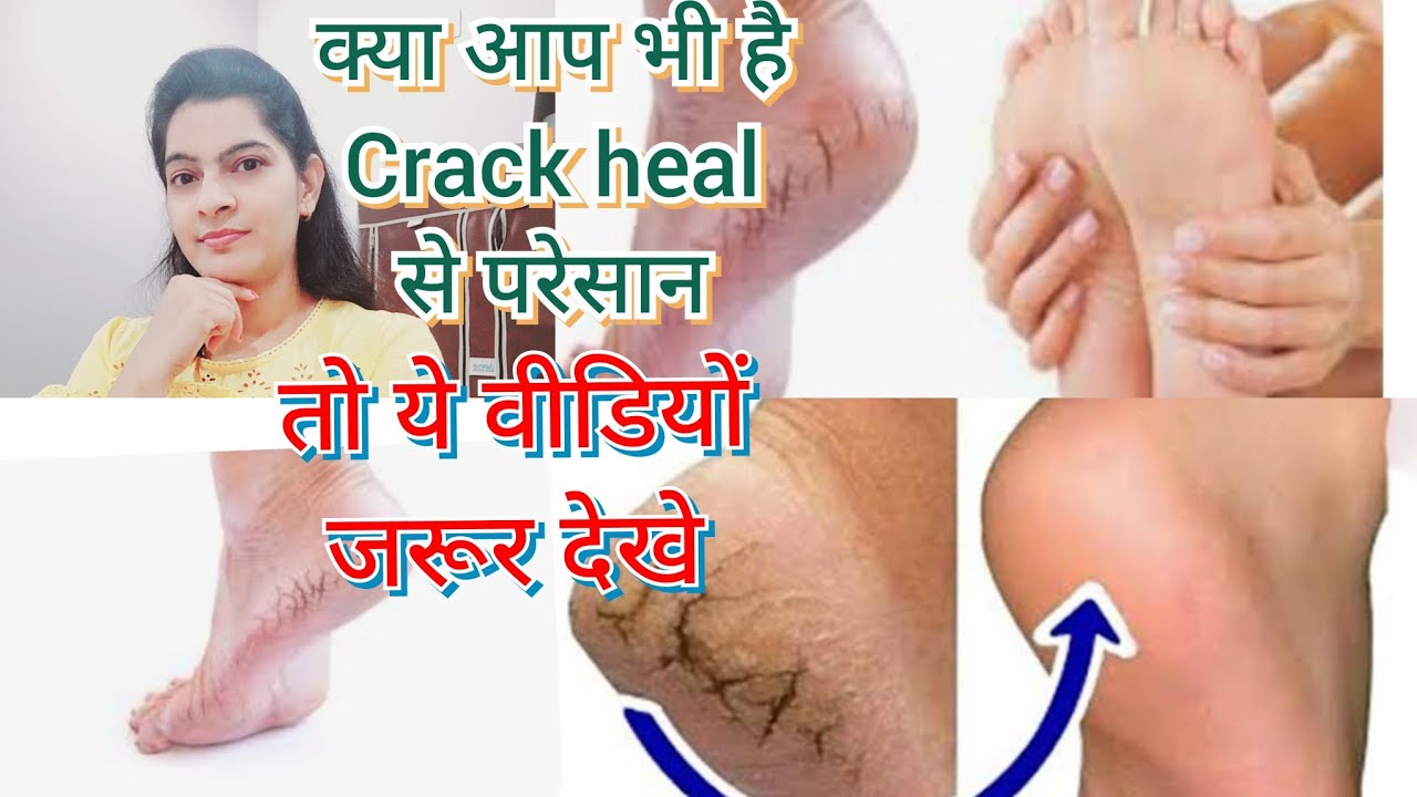 How To Cure Cracked Heels best-way-to-get-rid-of-dry-and-cracked-heels-at-home-youtube