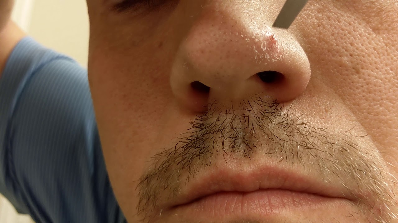 Nose hair penetrated to the outside of nose - YouTube