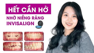 Niềng răng khớp cắn hở - Thoải mái, hiệu quả với Invisalign